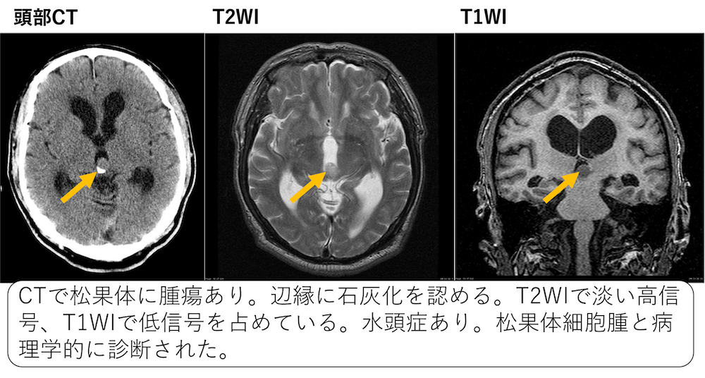 松果体実質腫瘍のCT、MRI画像所見